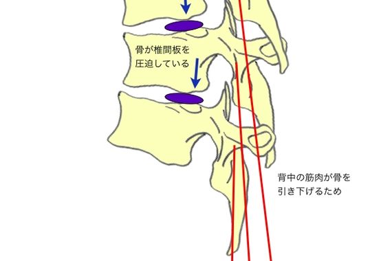 根元から腰痛を改善
